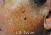 non surgical laser removal mole before (180)